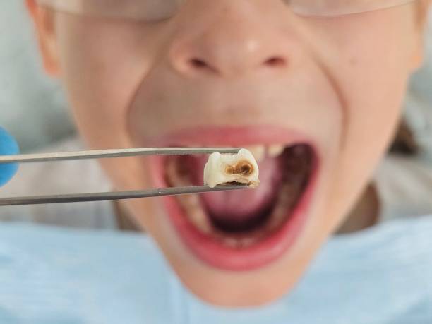 Best Emergency Broken Tooth Repair in Bethany, WV
