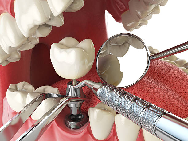 Best Emergency Wisdom Teeth Removal in Bethany, WV